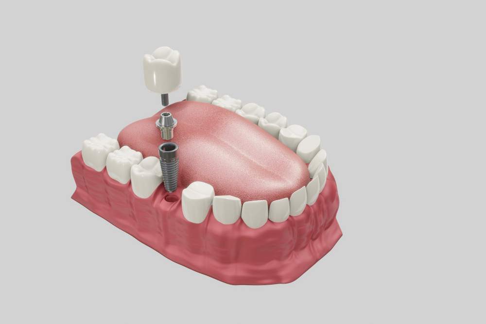 Implantes dentales en Guadalajara